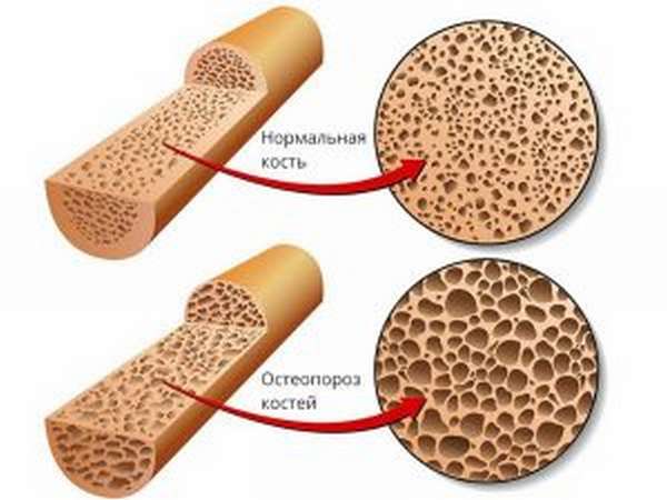 Причины и лечение остеопороза турецкого седла